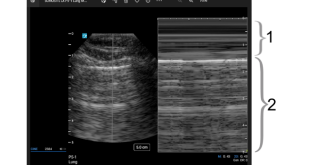 Lung view – eFAST Lung view – eFAST