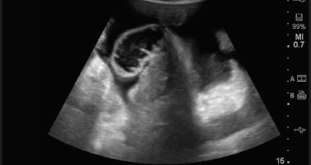 Free fluid in the pelvis – eFAST
