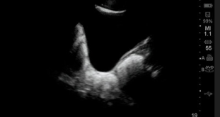 Normal bladder (pelvic) Normal bladder (pelvic)