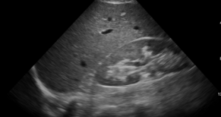 RUQ (Right Upper Quadrant) – eFAST RUQ (Right Upper Quadrant) – eFAST