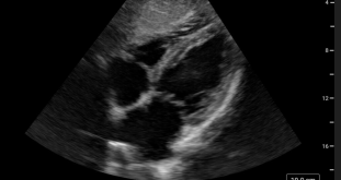 Cardiac view – eFAST Cardiac view – eFAST