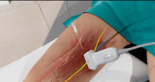 Infographic of Adductor canal block