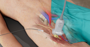 Image of femoral block 